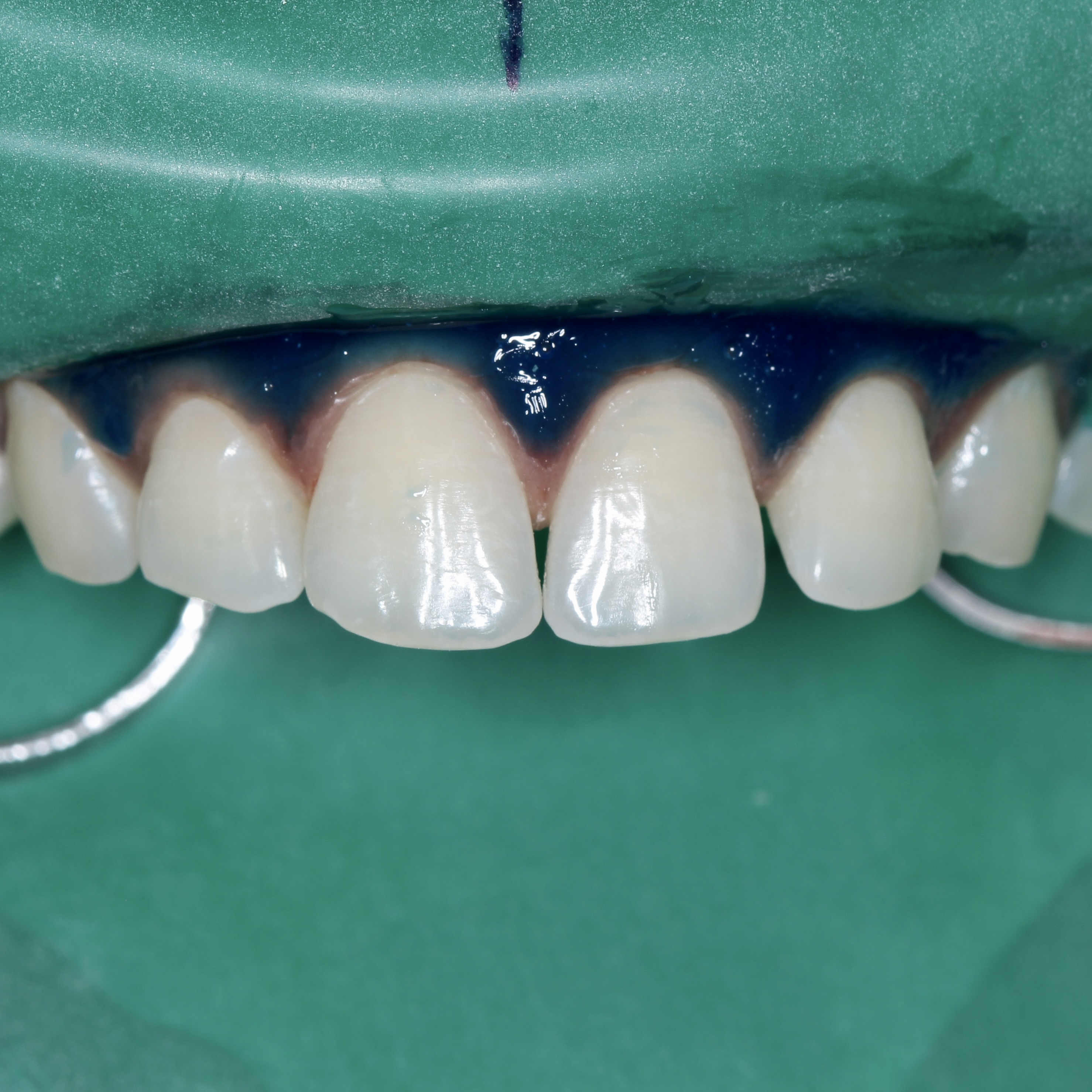 Clinical Isolation